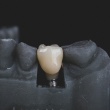 Navigating the World of Dental Implants: A Complete Overview for a Brighter Smile
