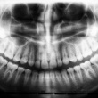 Dental Crowns: The Keystone of Restorative Dentistry
