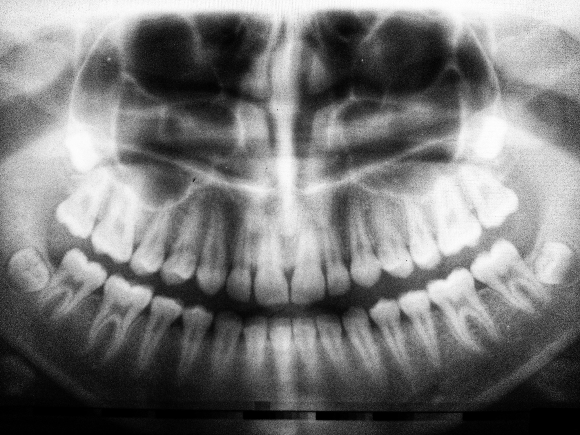 dental crowns