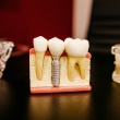 Exploring the Viability of Dental Implants