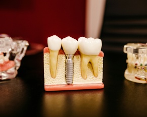 dental implants in-home care