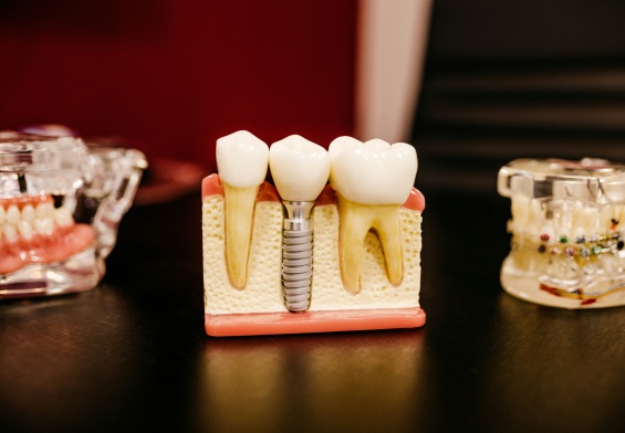dental implants in-home care
