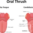 What Is Oral Thrush?