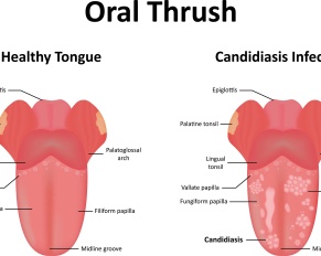 What is Oral Thrush?