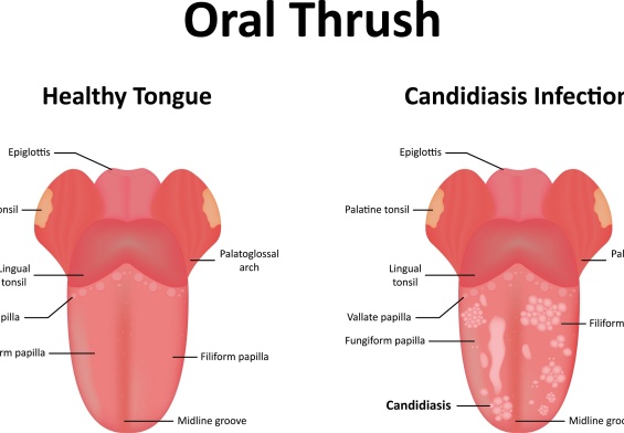 What is Oral Thrush?