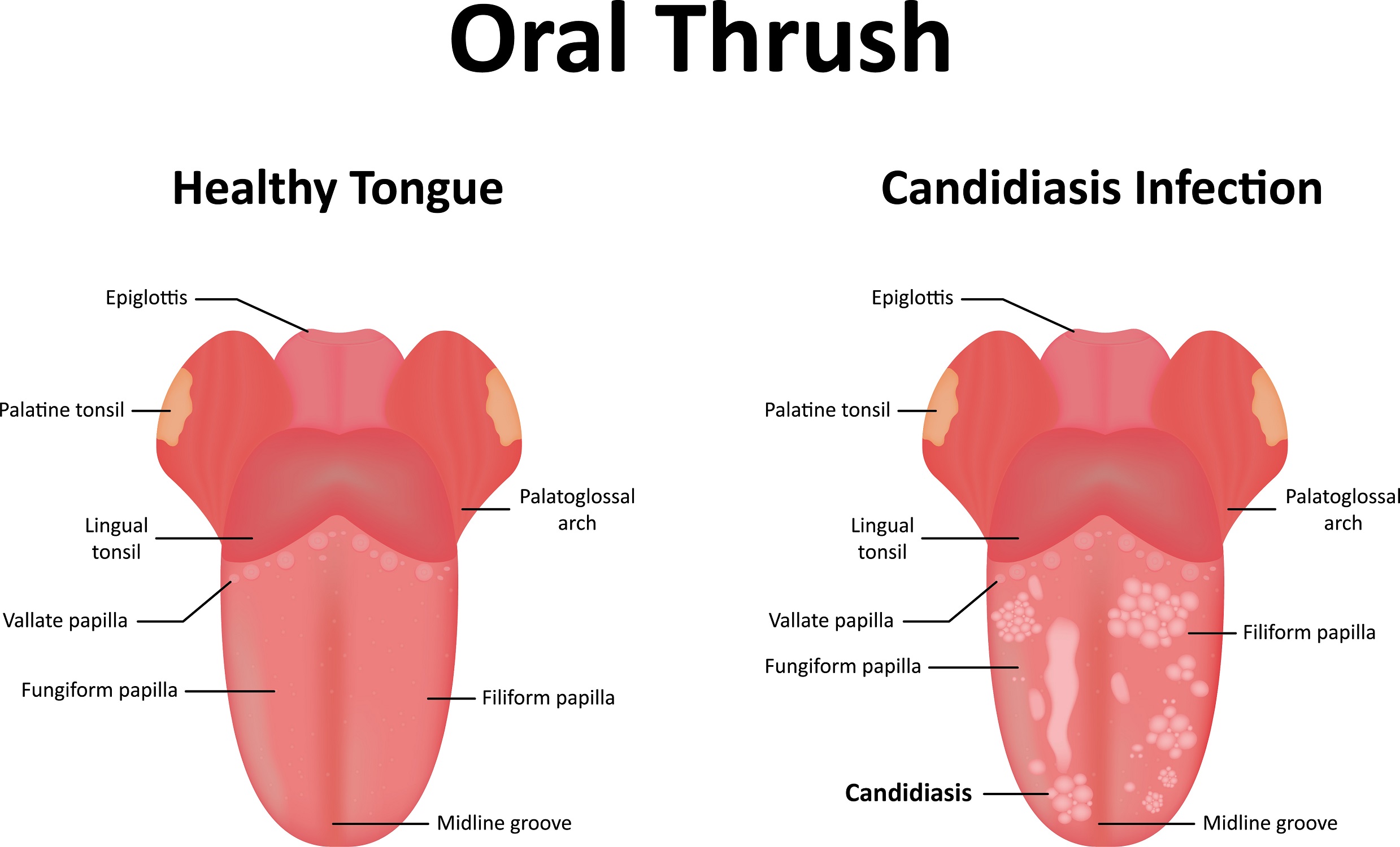 What is Oral Thrush?