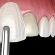 What You Need to Know Before Getting Dental Veneers