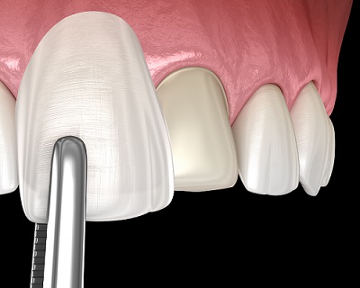 dental veneer installation procedure