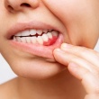 Periodontal Disease and Dental Implants