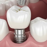 Veneers vs. Composite Bonding: Which Smile Fix Actually Lasts in New Jersey?