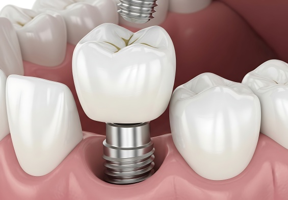 veneers vs composite bonding which smile fix lasts in NJ