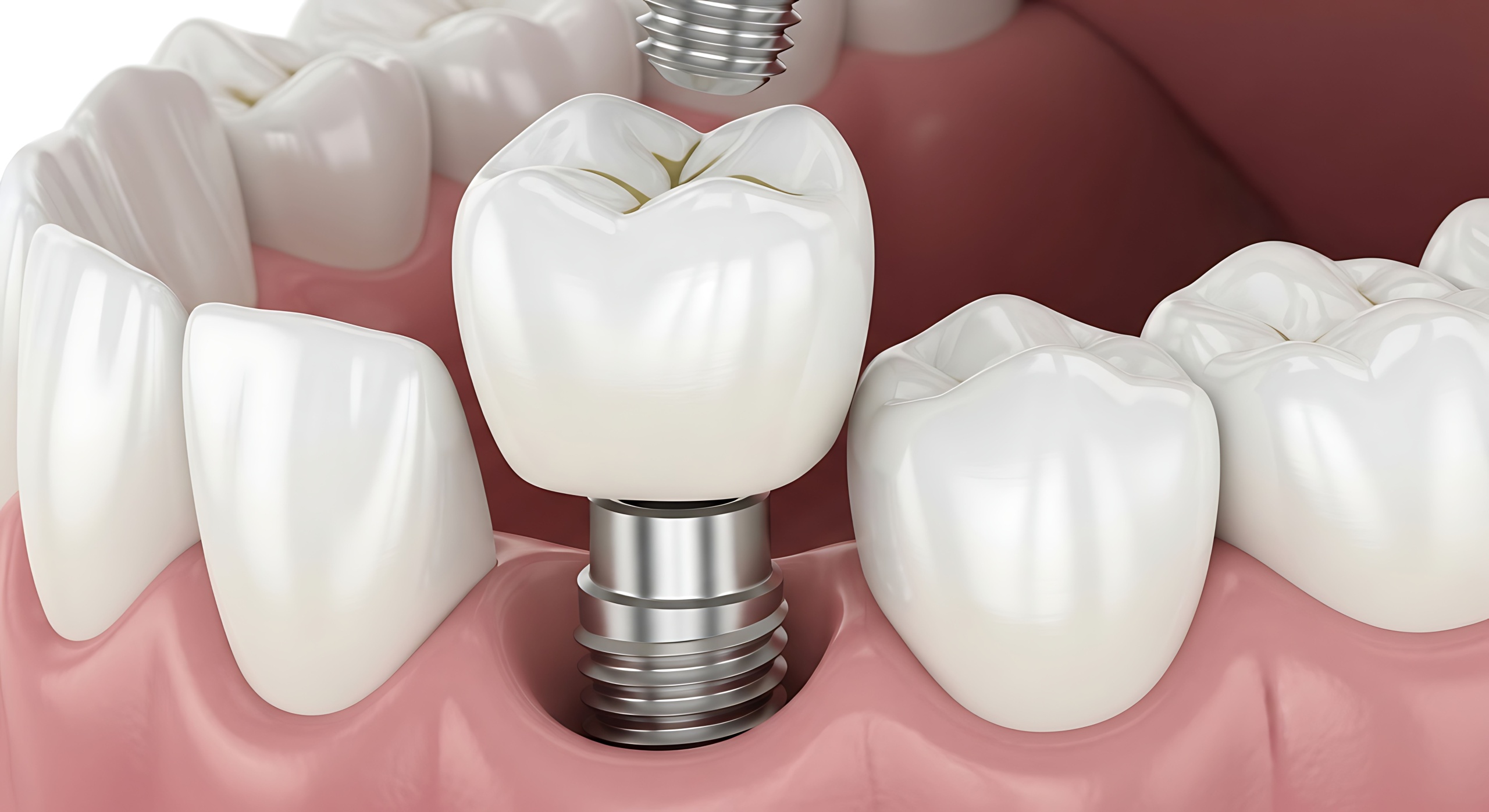 veneers vs composite bonding which smile fix lasts in NJ