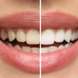 Teeth Whitening for Sensitive Teeth in NJ: What Actually Works and Why Some Methods Make It Worse