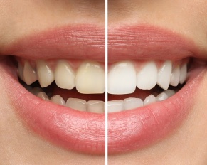 teeth whitening for sensitive teeth
