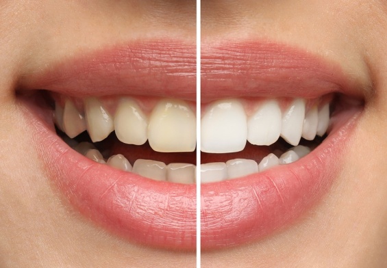 teeth whitening for sensitive teeth