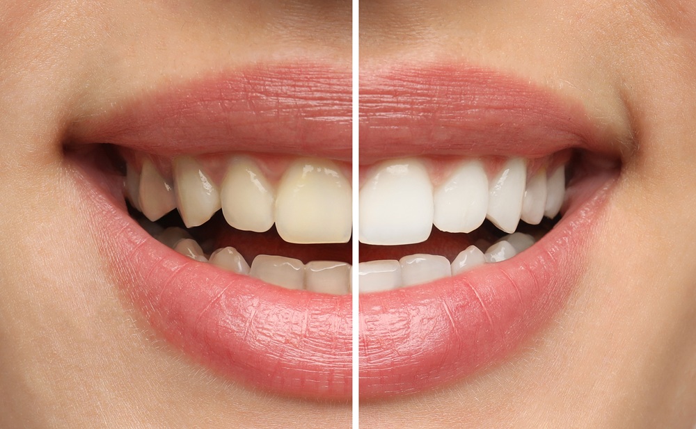 teeth whitening for sensitive teeth