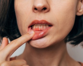 dental bleeding
