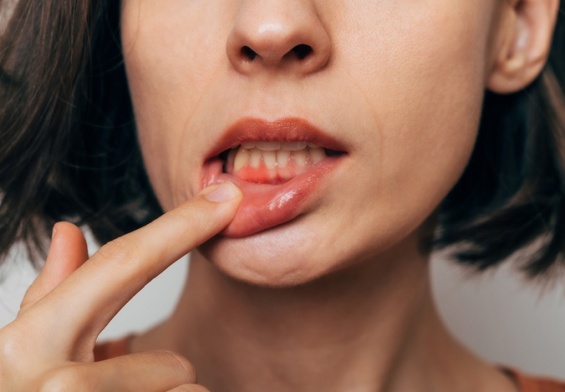dental bleeding